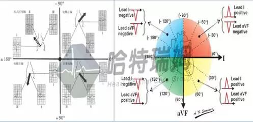 心电图怎么切换导联原来读懂心电图可以如此简单！_https://www.jmylbn.com_新闻资讯_第15张