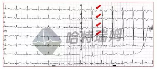 心电图怎么切换导联原来读懂心电图可以如此简单！_https://www.jmylbn.com_新闻资讯_第5张