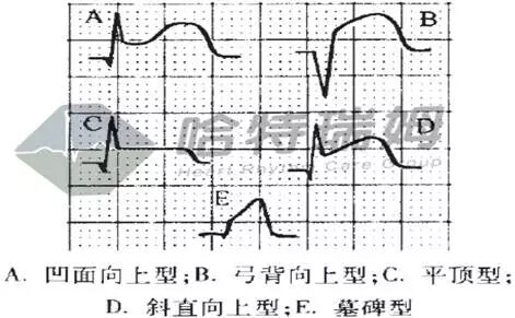 心电图怎么切换导联原来读懂心电图可以如此简单！_https://www.jmylbn.com_新闻资讯_第32张