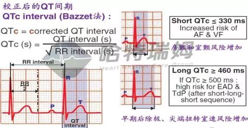心电图怎么切换导联原来读懂心电图可以如此简单！_https://www.jmylbn.com_新闻资讯_第27张