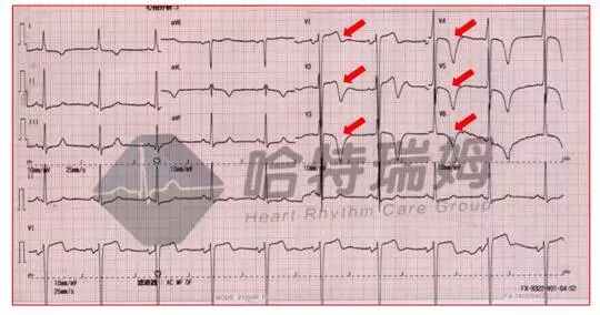心电图怎么切换导联原来读懂心电图可以如此简单！_https://www.jmylbn.com_新闻资讯_第10张