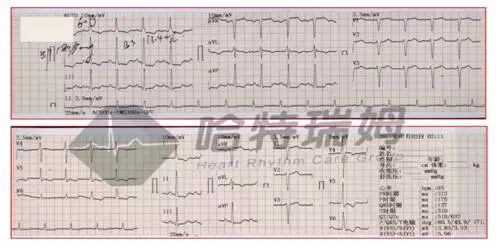 心电图怎么切换导联原来读懂心电图可以如此简单！_https://www.jmylbn.com_新闻资讯_第9张