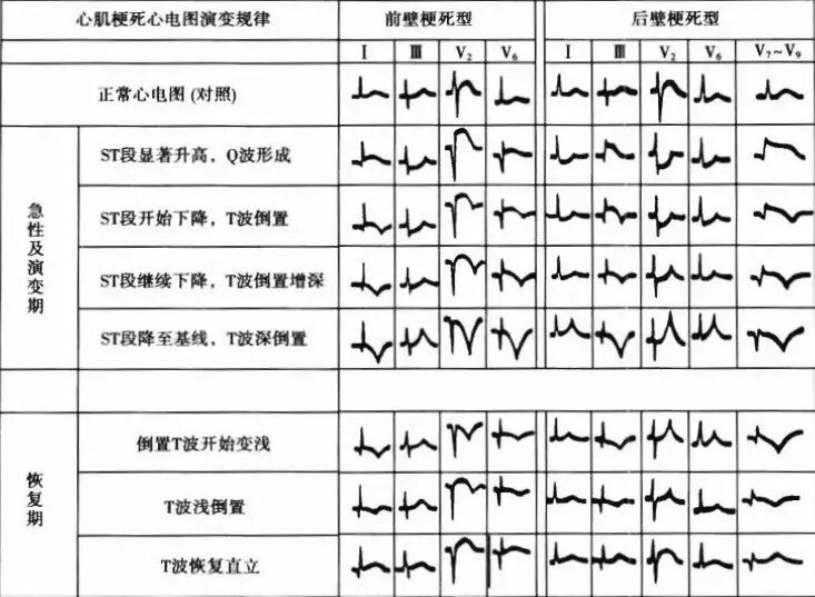 13种引起st段抬高的疾病你都了解吗