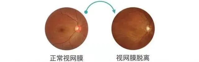 眼底照相机怎么眼底一张照眼病早知道丨蔡司CLARUS 500真彩·高清·超广角眼底相机_https://www.jmylbn.com_新闻资讯_第7张