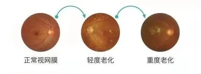 眼底照相机怎么眼底一张照眼病早知道丨蔡司CLARUS 500真彩·高清·超广角眼底相机_https://www.jmylbn.com_新闻资讯_第5张