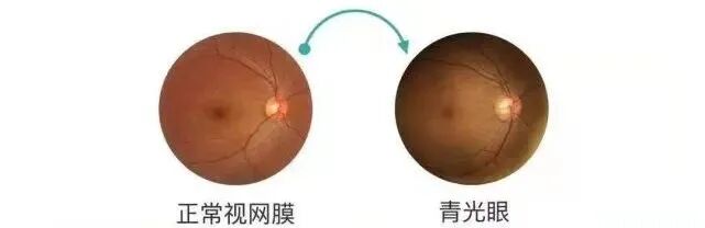 眼底照相机怎么眼底一张照眼病早知道丨蔡司CLARUS 500真彩·高清·超广角眼底相机_https://www.jmylbn.com_新闻资讯_第6张