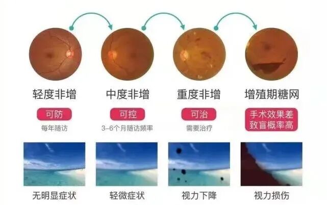 眼底照相机怎么眼底一张照眼病早知道丨蔡司CLARUS 500真彩·高清·超广角眼底相机_https://www.jmylbn.com_新闻资讯_第4张