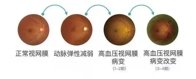 眼底照相机怎么眼底一张照眼病早知道丨蔡司CLARUS 500真彩·高清·超广角眼底相机_https://www.jmylbn.com_新闻资讯_第3张