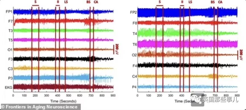 临死前看到”人生走马灯”可能真存在?!科学家观测濒死脑电波，都和回忆有关！