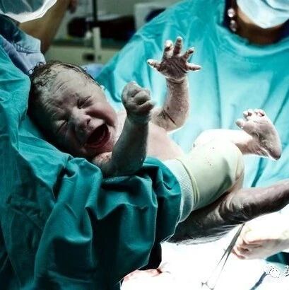 新生儿胃部异常大，医生惊讶发现，宝宝胃里还有一个"宝宝"！