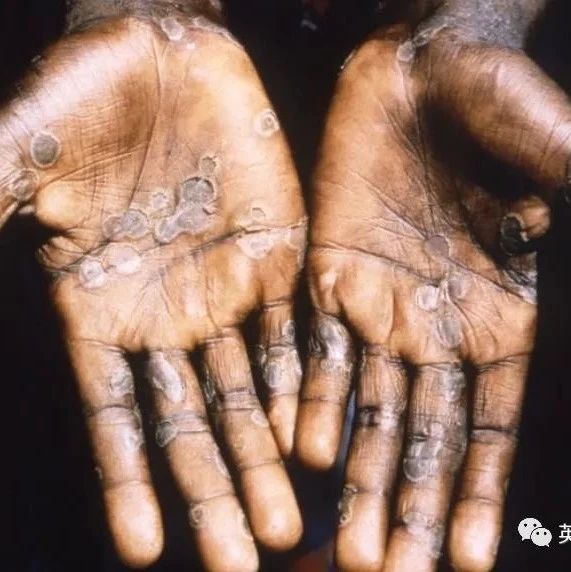 欧美多国爆发猴痘，最先在英国发现，部分病例在男同圈中传播！