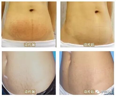 【伊美高科】INUS(伊诺锶)—怀孕也可以尽情炫腹!-怀孕期