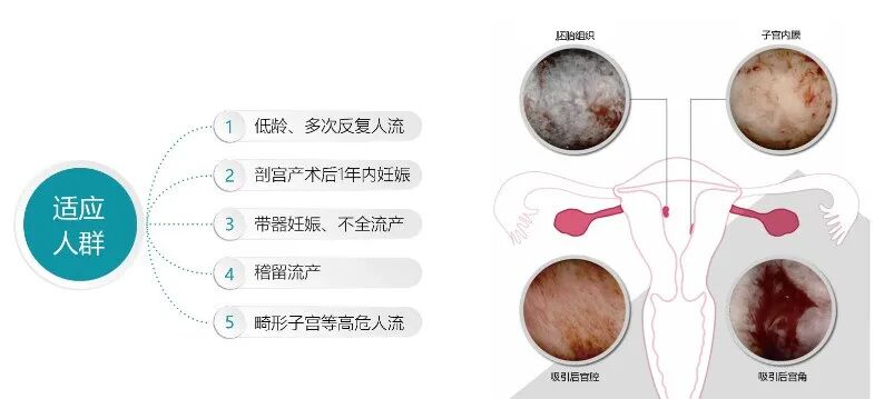人流吸引管怎么选择宫腔直视人流技术，避免盲刮，看得见的关爱_https://www.jmylbn.com_新闻资讯_第7张