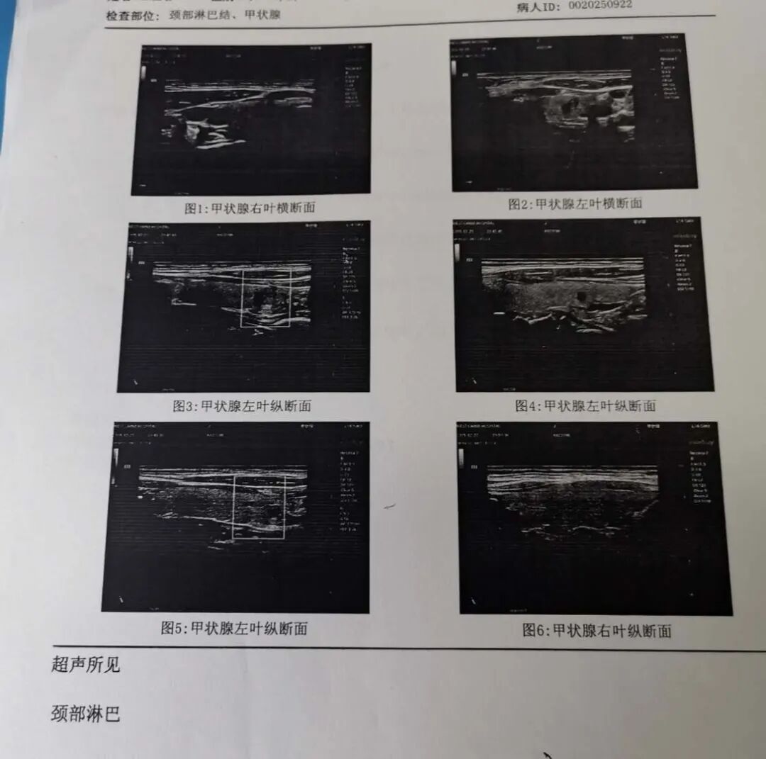 图片[2]-穿刺活检，进一步辨别良恶性因“冠状病毒肺炎”-首码网-网上创业赚钱首码项目发布推广平台