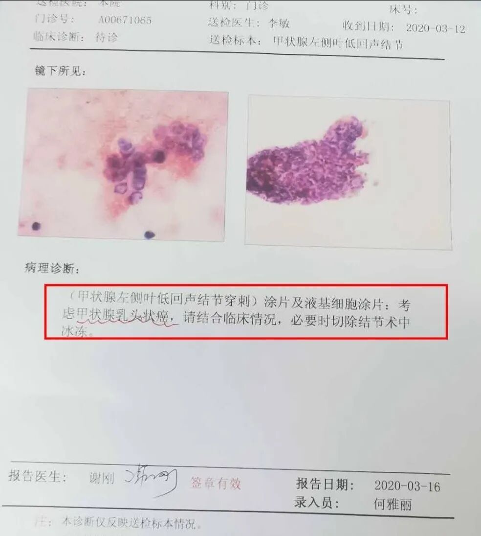 图片[5]-穿刺活检，进一步辨别良恶性因“冠状病毒肺炎”-首码网-网上创业赚钱首码项目发布推广平台