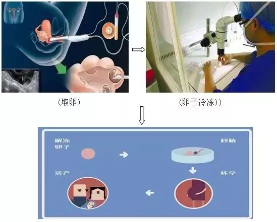 大不了冷冻卵子 冷冻卵子复苏后的成功率怎么样 新闻资讯 深圳美研海外医疗咨询有限公司 美研海外医疗