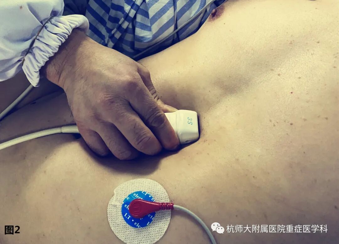 什么是超声容积探头重症心脏超声图像的获取_https://www.jmylbn.com_新闻资讯_第6张