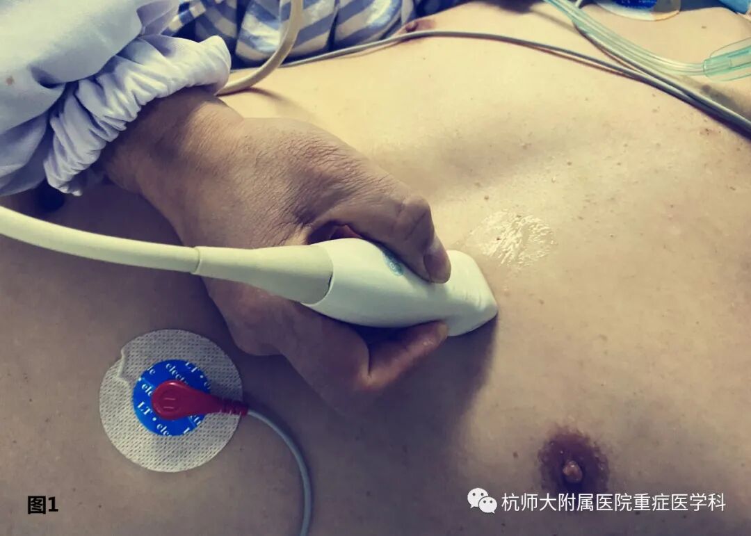 什么是超声容积探头重症心脏超声图像的获取_https://www.jmylbn.com_新闻资讯_第5张