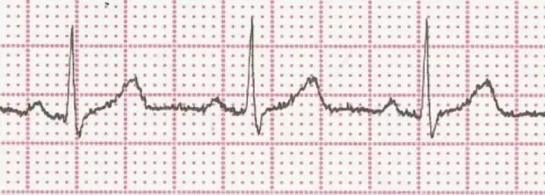 什么是aed除颤AED介绍及除颤原理_https://www.jmylbn.com_新闻资讯_第7张