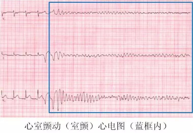 什么是aed除颤AED介绍及除颤原理_https://www.jmylbn.com_新闻资讯_第8张