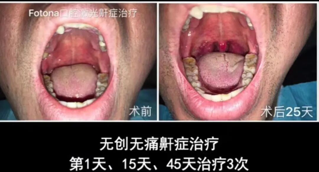 口腔激光怎么治疗你相信“光”吗？近距离了解航天中心医院口腔科激光治疗_https://www.jmylbn.com_新闻资讯_第22张