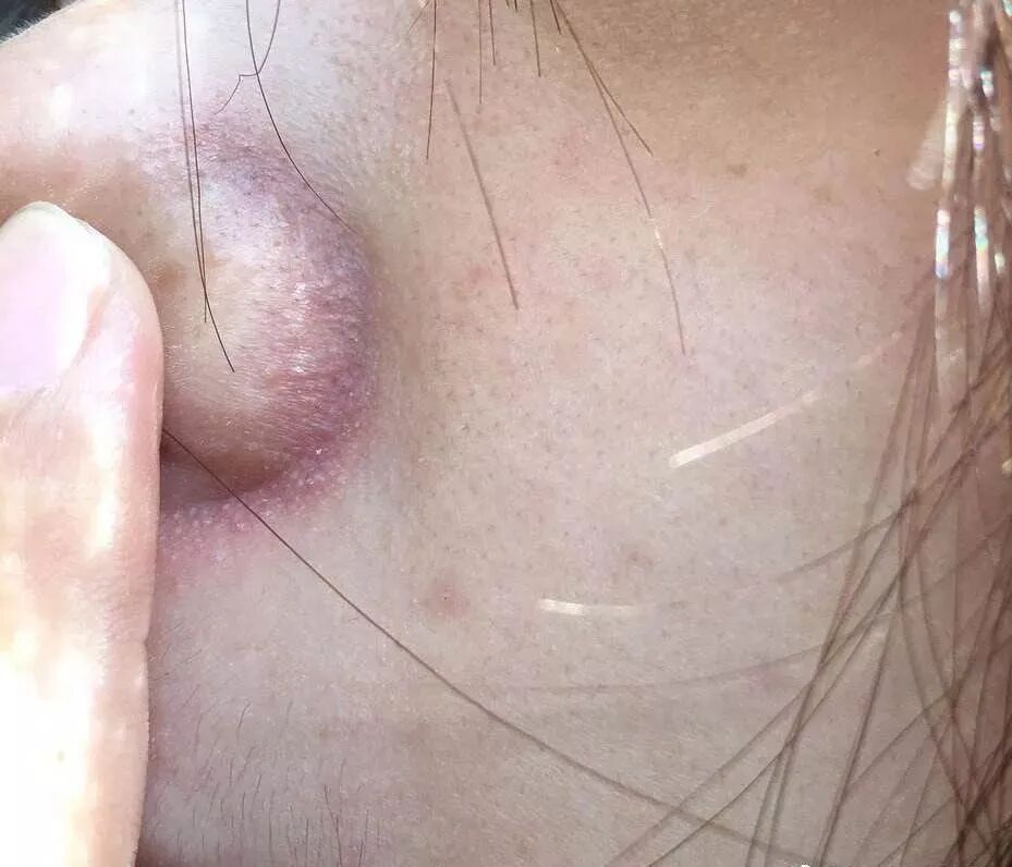 你还在为脂溢性皮炎困扰吗？