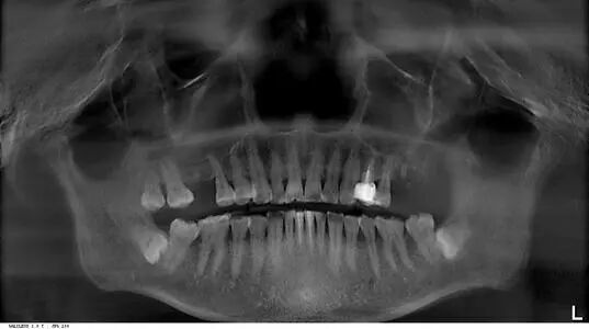 曲面断层片怎么看科普知识：你会看牙片嘛？今天手把手教你看！_https://www.jmylbn.com_新闻资讯_第15张