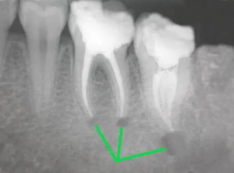 曲面断层片怎么看科普知识：你会看牙片嘛？今天手把手教你看！_https://www.jmylbn.com_新闻资讯_第18张