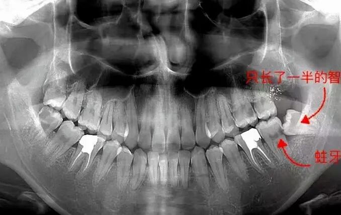 曲面断层片怎么看科普知识：你会看牙片嘛？今天手把手教你看！_https://www.jmylbn.com_新闻资讯_第11张
