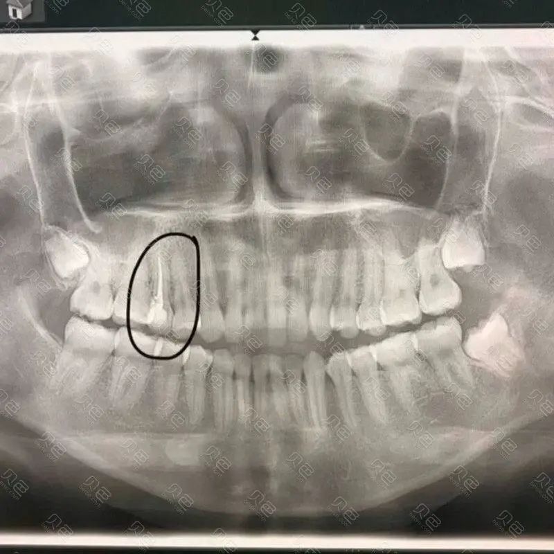 曲面断层片怎么看科普知识：你会看牙片嘛？今天手把手教你看！_https://www.jmylbn.com_新闻资讯_第13张