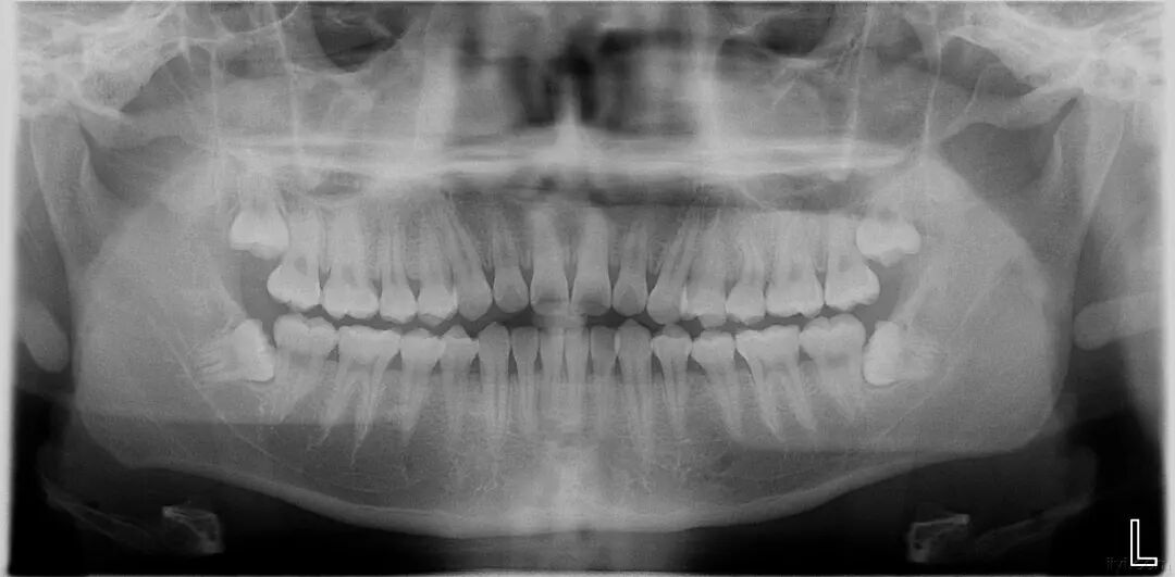 曲面断层片怎么看科普知识：你会看牙片嘛？今天手把手教你看！_https://www.jmylbn.com_新闻资讯_第4张