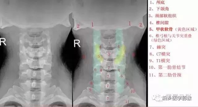 圖文並茂 詳細的頸椎x線解剖 解讀 Haoyisheng 微文庫