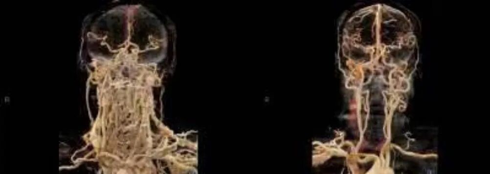 为什么要用动脉留置针【科普】右手优先？为什么CT增强留置针有这样说法？_https://www.jmylbn.com_新闻资讯_第10张