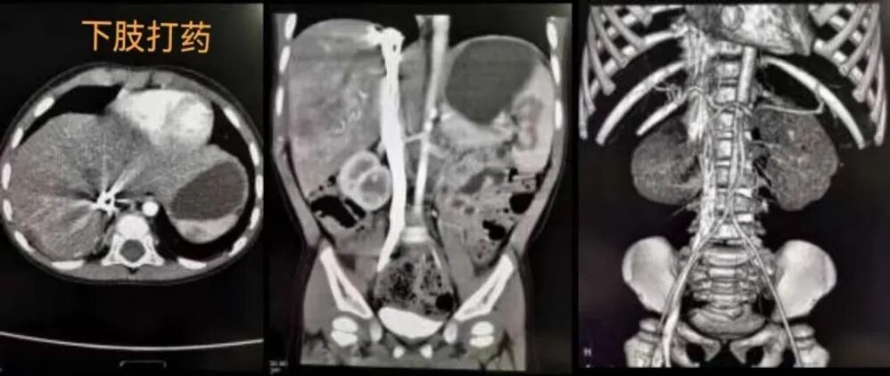 为什么要用动脉留置针【科普】右手优先？为什么CT增强留置针有这样说法？_https://www.jmylbn.com_新闻资讯_第12张