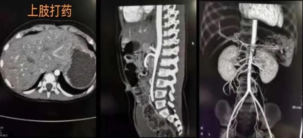 为什么要用动脉留置针【科普】右手优先？为什么CT增强留置针有这样说法？_https://www.jmylbn.com_新闻资讯_第11张