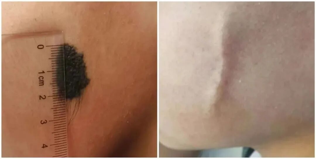 什么是缝线胶超减张精细缝合——让伤口疤痕最小化_https://www.jmylbn.com_新闻资讯_第4张