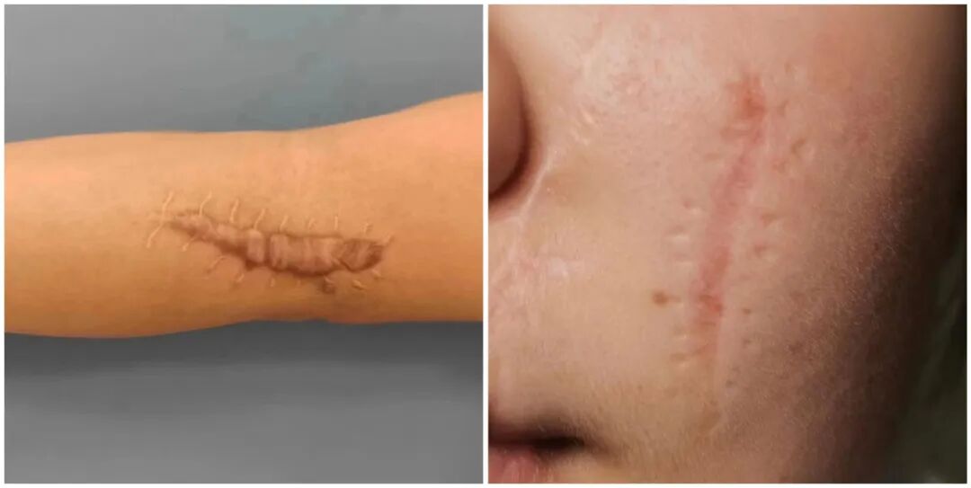 什么是缝线胶超减张精细缝合——让伤口疤痕最小化_https://www.jmylbn.com_新闻资讯_第2张