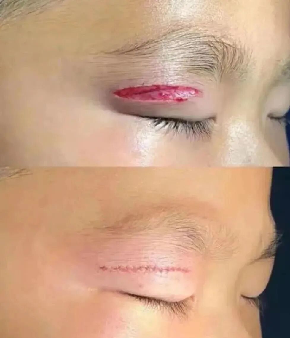 什么是缝线胶超减张精细缝合——让伤口疤痕最小化_https://www.jmylbn.com_新闻资讯_第3张