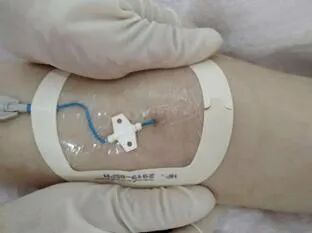 picc导管是什么材质关于“PICC”那些事_https://www.jmylbn.com_新闻资讯_第13张