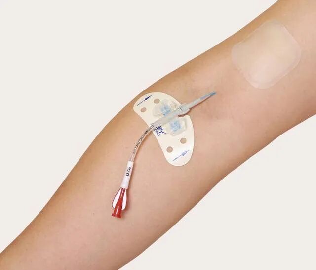 picc导管是什么材质关于“PICC”那些事_https://www.jmylbn.com_新闻资讯_第6张