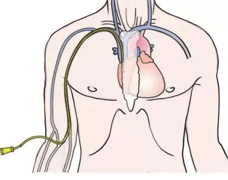 picc导管是什么材质关于“PICC”那些事_https://www.jmylbn.com_新闻资讯_第5张