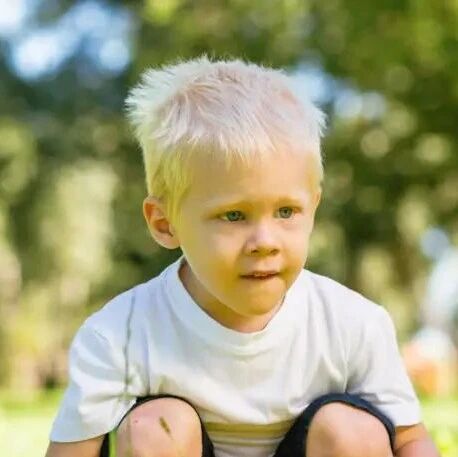 罕见病诊疗指南（2019 年版）- 白化病