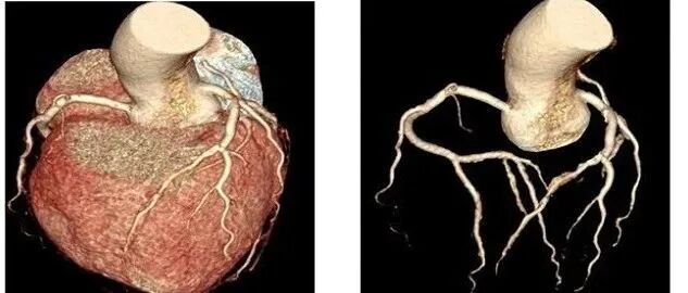 冠脉CTA天天看，你真的懂它吗？