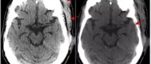 头颅 CT 七大陷阱 你可别中招
