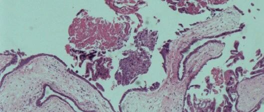 双胎之一葡萄胎16周成功引产阴道分娩一例