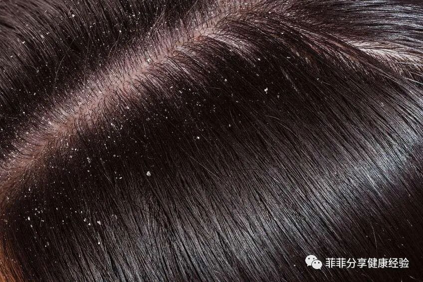 每天洗头还有很多头皮屑，或与这3个疾病有关，做好4点或能缓解