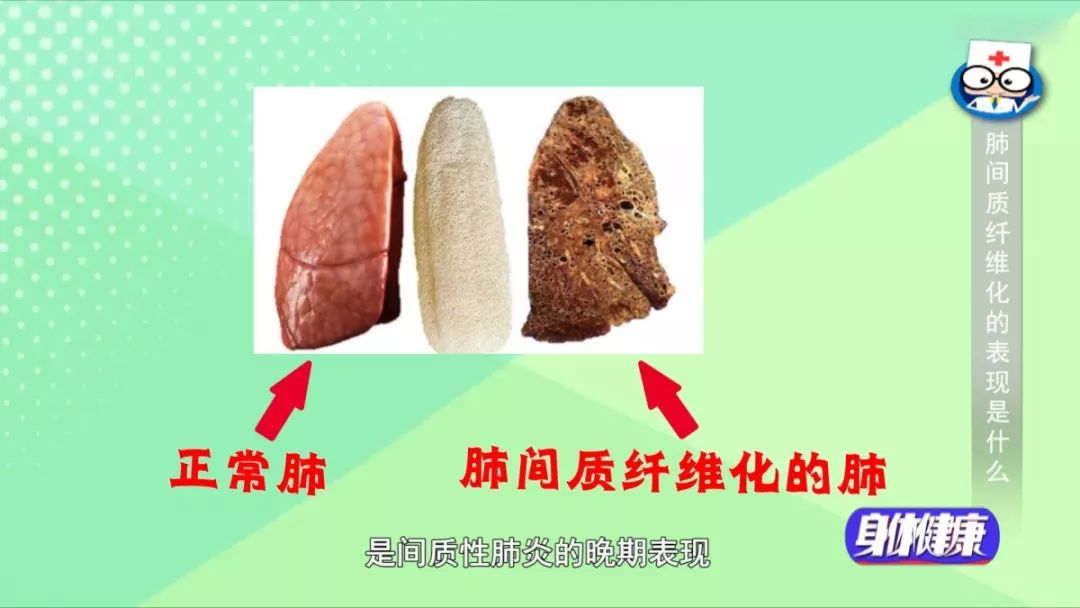 胸悶氣短？當心出現這個病 健康 第4張