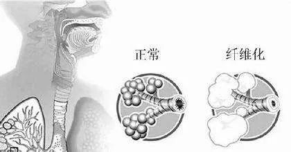 胸悶氣短？當心出現這個病 健康 第3張