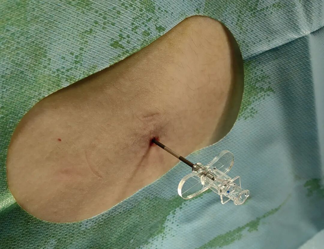 怎么知道穿刺到硬膜外硬膜外穿刺针需要略加改进_https://www.jmylbn.com_新闻资讯_第3张