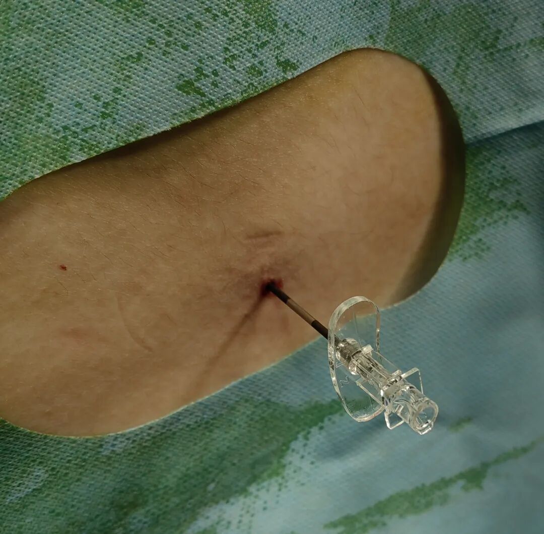 怎么知道穿刺到硬膜外硬膜外穿刺针需要略加改进_https://www.jmylbn.com_新闻资讯_第2张